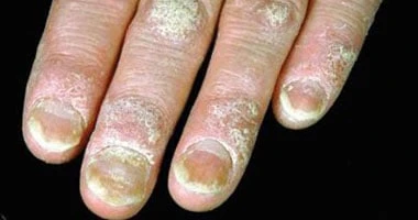 ..أكلات تخفف آلام المفاصل والتهابات الجسم لمرضى الصدفية..تفاصيل تتابع الان تفاصيل ما ورد عن أكلات تخفف آلام المفاصل والتهابات الجسم لمرضى الصدفية،