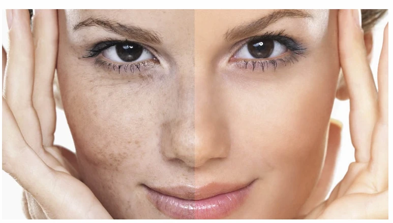 وصفات لازالة التصبغات الجلدية.. وشك هيرجع له نضارته من تاني وصفات لازالة التصبغات الجلدية، حيث أن لا يتوقف وجود التصبغات على أي نوع معين من البشرة،