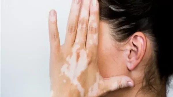 في اليوم العالمي للبهاق.. أسباب وعلامات غير متوقعة يصادف اليوم 25 يونيو اليوم العالمي للبهاق، وهو حالة تؤدي إلى فقدان الجلد لونه، يمكن أن يحدث هذا الاضطراب الجلدي عند الأشخاص من أي