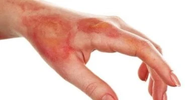 علاجات منزلية فعالة للحروق الطفيفة.. حلول بسيطة لتسكينها وعلاجها صحة وطب شاهد المقال التالي من صحافة مصر عن علاجات منزلية فعالة للحروق الطفيفة حلول