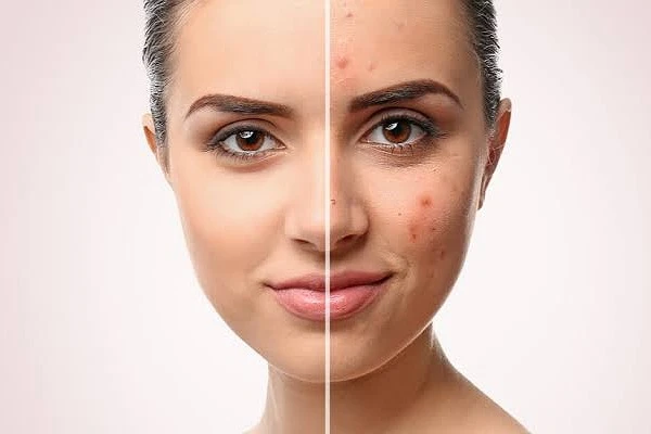 وقاية وعلاج من حبوب الشباب.. خطوات فعالة لبشرة صحية.تعد حبوب الشباب مشكلة شائعة تؤثر على العديد من الأفراد، خاصة خلال فترة المراهقة وأوائل العشرينات. يمكن أن تكون هذه البثور والرؤو