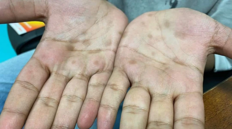 إصابة مراهق ب الزهري بعد علاقة مع خادمة إفريقية كشف أستاذ الأمراض الجلدية والتناسلية والذكورة بطب عين شمس، الدكتور محمد عبدالنعيم، إصابة مراهق مصري