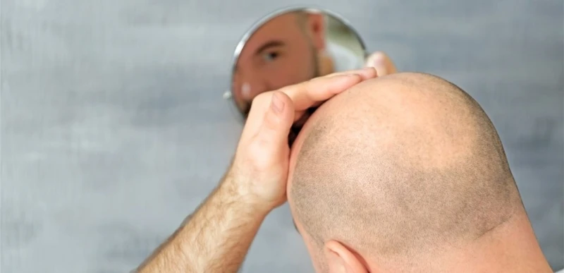 بالصدفة.. اكتشاف علاج ثوري للصلع! صحة شاهد المقال التالي من صحافة لبنان عن بالصدفة اكتشاف علاج ثوري للصلع!، عثر علماء عن طريق الصدفة، على علاج جديد