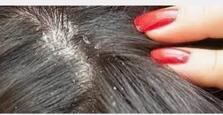 ما هو تفسير حلم القمل في الشعر وقتله لابن سيرين والنابلسي؟ تفسير حلم القمل في الشعر وقتله، ما هي دلالة رؤية قتل القمل الكبير في المنام؟، وماذا قال