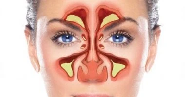ما يجب تناوله أو الابتعاد عنه إذا كنت تعانى من التهاب الجيوب الأنفية؟ صحة وطب شاهد المقال التالي من صحافة مصر عن ما يجب تناوله أو الابتعاد عنه إذا