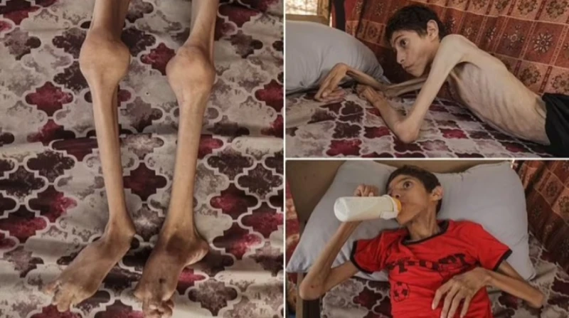 هيكل عظمي.. صور مأساوية لفلسطيني يعاني من سوء التغذية الحاد كشفت صور صادمة من غزة، التأثير المدمر لسوء التغذية الحاد على المحاصرين في القطاع الذي