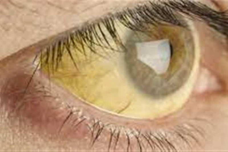 في اليوم العالمي لالتهاب الكبد.. هل يعد تطعيم فيروس ضروري بالنسبة لك؟ يوافق اليوم العالمي لالتهاب الكبد، اليوم الأحد، الموافق 288، ويهدف اليوم