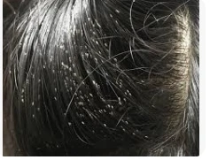 ماذا لو حلمت أني أخرج قمل من شعر أختي لابن سيرين؟ ماذا لو حلمت أني أخرج قمل من شعر أختي لابن سيرين؟، يعتقد المفسرون أن المنام يشير إلى الخير ويحمل الكثير من البشائر للحالم ولكنه قد