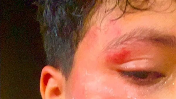 صفع نجل الإعلامية شذا شعبان على يد شاب بالساحل الشمالي تعرض طفل يدعى أحمد زكريا 12 سنة و 4 أطفال آخرين للصفع باليد الحديدية من قبل شاب يدعى محمود . أ بالساحل الشمالي في مارينا 2 أث