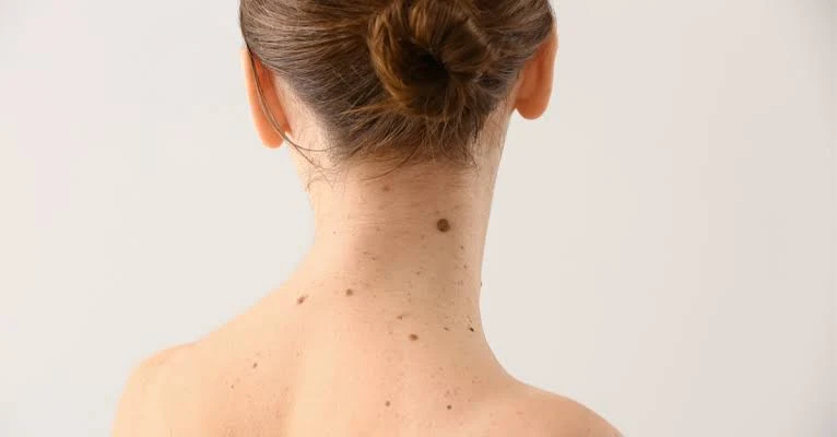 إذا كانت هذه العلامات في جسمك .. فأنت محظوظ.يعتقد البعض أن هناك بعض العلامات في الجسم تدل على الخير أو الحظ السعيد، حيث يتأثر الكثير من الأشخاص ببعض