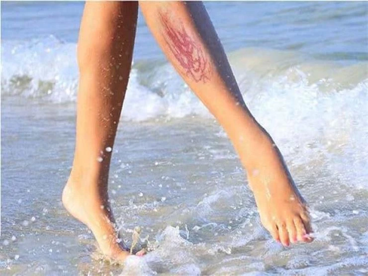 كيف تتعامل مع لسعة قنديل البحر؟ نصائح طبية مهمة لايف ستايل شاهد المقال التالي من صحافة مصر عن كيف تتعامل مع لسعة قنديل البحر؟ نصائح طبية مهمة، 02 01