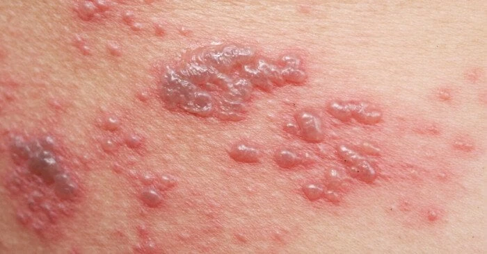 لتجنب انتشار العدوى بالحزام الناري.. نصائح مهمة من هيئة الدواءالحزام الناري أحد أشهر أنواع العدوى الفيروسية التي تؤدي إلى ظهور بعض الأعراض أشهرها