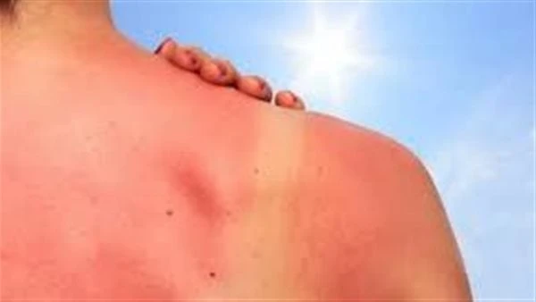 وصفات طبيعية للتخلص من حروق الشمس.. جل الصبار والزبادي الأبرز هناك عدة وصفات طبيعية فعالة للتخلص من حروق الشمس، وفيما يلي أبرزها، وفقا لما نشرة موقع إكسبريس. 1. جل الصبار- يحتوي جل