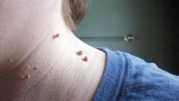 رخيصة وطبيعية .. وصفة غير متوقعة لعلاج الزوائد الجلدية تعد الزوائد الجلدية من المشكلات الصحية المنتشرة بين النساء والرجال وتشوه مظهر البشرة .ووفقا لما جاء في موقع فاكت اند فن نكشف 