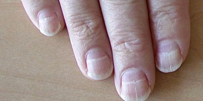 إذا رأيت هذه العلامات على أظافرك.. فاحذر الكوليسترول الضار منوعات الاسبوع شاهد المقال التالي من صحافة مصر عن إذا رأيت هذه العلامات على أظافرك فاحذر