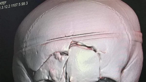 سقط من الدور الثالث .. مستشفى كفر شكر تنقذ حياة طفل من الموت كشف الدكتور محمد ناجي مدير مستشفي كفر شكر التخصصي تفاصيل إنقاذ طفل يبلغ من العمر ٩ سنوات