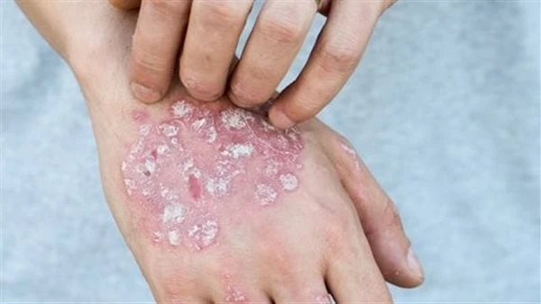 يتسبب في تغيير الشكل ومزمن .. 4 طرق لعلاج الصدفية تعد الصدفية من الأمراض المناعية المزمنة التي تصيب الجلد والبشرة الخارجية وتغير مظهرها للاسوأ.ووفقا لما ذكره موقع هيلث شوتس فإنه لا