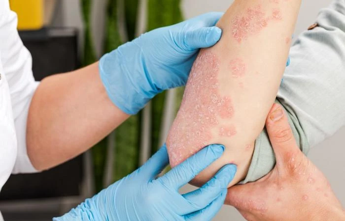 ما هو تقشر الأنسجة المتموتة البشروية التسممي ؟ تقشر الأنسجة المتموتة البشروية التسممي هو حالة جلدية مؤلمة مهددة للحياة تسبب تكون فقاعات وتقشر مساحات كبيرة من الجلد، تغطي على الأقل