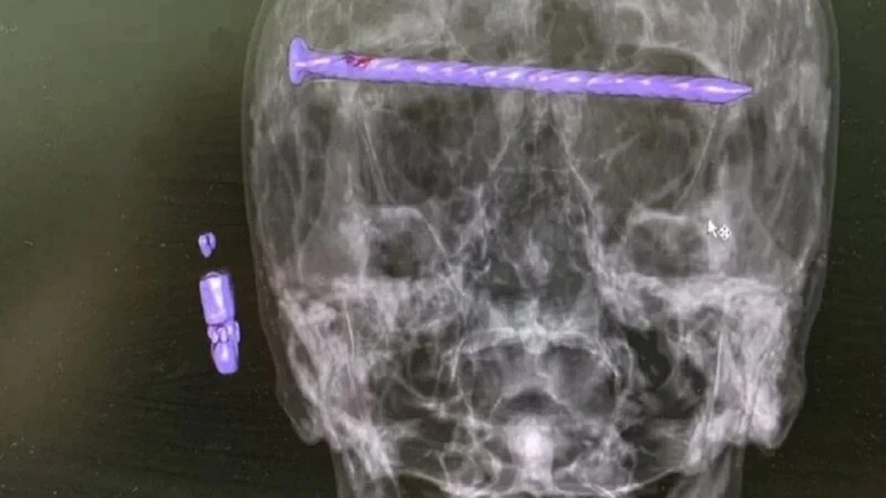 إخراج مسمار طوله 15 سم من رأس مسن .. صورة اخر خبر شاهد المقال التالي من صحافة السعودية عن إخراج مسمار طوله 15 سم من رأس مسن صورة، في واقعة نادرة من نوعها ، تمكن جراحون روس من انتشا