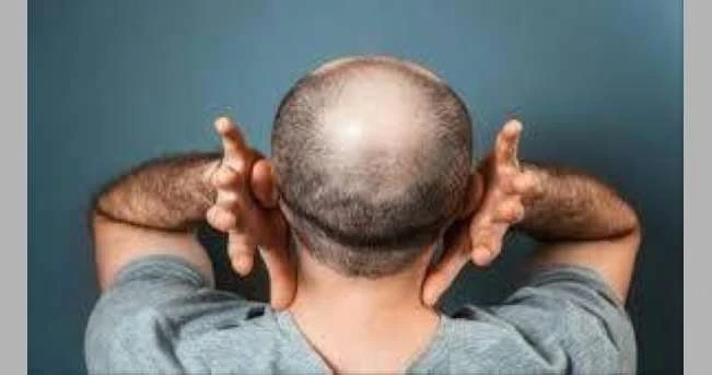 علماء: تطوير عقار جديد قد يكون طفرة في علاج الصلع الوراثي لايف ستايل شاهد المقال التالي من صحافة البحرين عن علماء تطوير عقار جديد قد يكون طفرة في