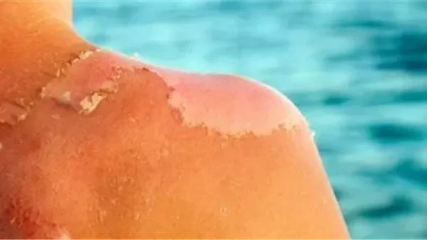 10 حلول لتقشير البشرة بسبب حروق الشمس وطرق الحمايةيتعرض الكثير من الأشخاص خلال فصل الصيف لتقشير البشرة، نتيجة لحروق الشمس، إليك 10 حلول مفيدة لتقشير