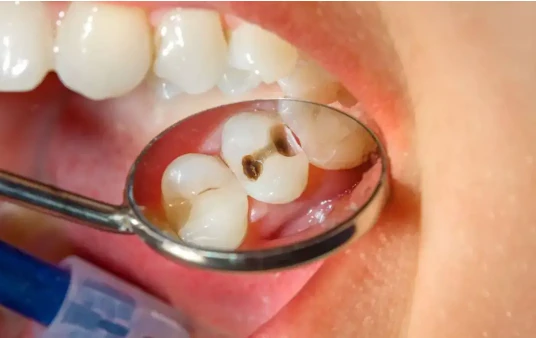 تعرف على تفسير حلم تفتت الضرس لابن سيرين و حلم تفتت الضرس المسوس تفسير حلم تفتت الضرس، كثيرا من الأشخاص يرغبون في تفسيره ومعرفة الرموز والدلالات التي تشير له، كما أن التفسير لهذا ا