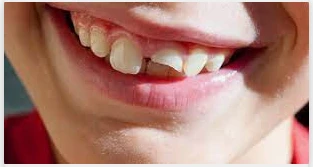 ما هو تفسير حلم كسر السن لابن سيرين؟ تفسير حلم كسر السن، من الأمور المزعجة أن يرى الفرد في منامه كسر السن ويزداد الضرر إذا شعر بالألم أيضا وشاهد شكل