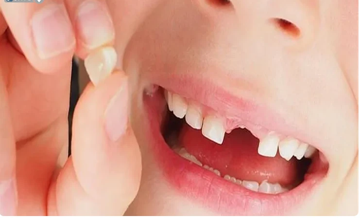 ما هو تفسير حلم الأسنان تطيح لابن سيرين؟ سقوط الأسنان في الواقع مرتبط بألم لا يوصف وقد يقر البعض أنه لا يوجد ألم يعلو عن ألم الأسنان، لذلك رؤية