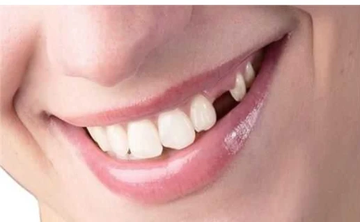 تعرف على تفسير تساقط الأسنان في المنام لابن سيرين التفسيرات التي يحملها حلم تساقط الاسنان في المنام موضع اهتمام الكثير من الأشخاص خاصة لمن لديهم حيرة