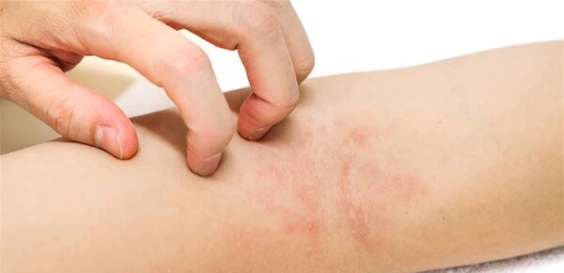 علاج احمرار الجلد والحكة الشديدة بسبب ارتفاع درجات الحرارة صحة شاهد المقال التالي من صحافة لبنان عن علاج احمرار الجلد والحكة الشديدة بسبب ارتفاع درجات الحرارة، علاج احمرار الجلد وا