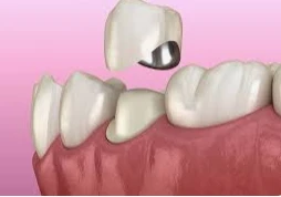 تأويلات ابن سيرين لرؤية خلع الضرس في المنام للمتزوجة تأويلات ابن سيرين لرؤية خلع الضرس في المنام للمتزوجة خلع الضرس في المنام للمتزوجة، إن رؤية