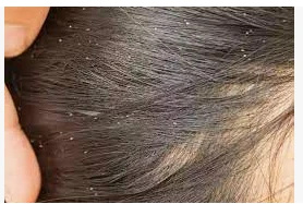 ما تفسير حلم القمل في الشعر للمتزوجة؟ ما تفسير حلم القمل في الشعر للمتزوجة؟ ، الكثير من السيدات يبحثن عن معنى رؤية القمل في الشعر خلال المنام وقد