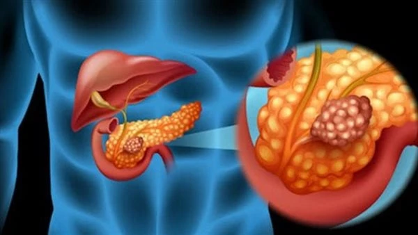 تحذير .. هؤلاء الأشخاص الأكثر عرضة لالتهاب البنكرياس يعد التهاب البنكرياس من المشكلات الصحية التي لا ينتبه لها الكثير من الأشخاص وتسبب مضاعفات عديدة