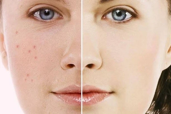 فهم تصبغات البشرة وسبل علاجها: دليل شاملتصبغات البشرة تشكل مشكلة شائعة قد تؤثر على مظهر البشرة، ويمكن أن تنجم عن عوامل متعددة. فيما يلي نظرة عامة على