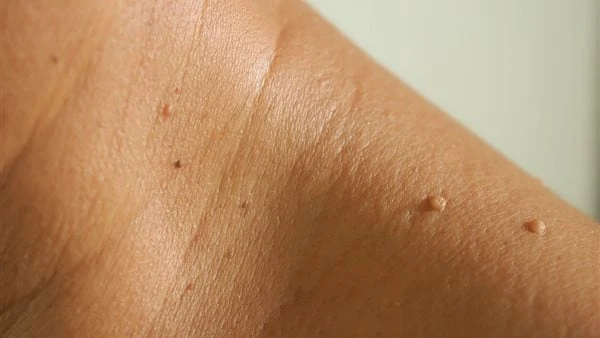 بدون أدوية.. كيف تتخلص من الزوائد الجلدية تعد الزوائد الجلدية من المشكلات الشائعة بين النساء والرجال ويصعب التخلص منها ولا تزول من تلقاء نفسها.ويبحث كثيرون عن طرق علاج الزوائد الجل