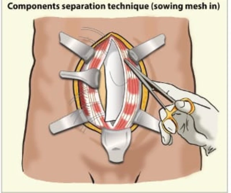 نجاح عملية إصلاح فتق الجدار البطني لستينية في مستشفى المواساة بالخبر الحياة شاهد المقال التالي من صحافة السعودية عن نجاح عملية إصلاح فتق الجدار