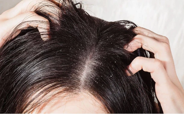 تعرف على تفسير حلم القمل لابن سيرين تعرف على تفسير حلم القمل لابن سيرين، تعتبر مشاهدة القمل في الحياة الواقعية من الأمور التي تبعث الإشمئزاز في نفس