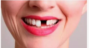 ما هو تفسير حلم سقوط سن واحد علوي للمتزوجة لابن سيرين؟ ما هو تفسير حلم سقوط سن واحد علوي للمتزوجة لابن سيرين؟ سقوط السن في الواقع يكون مرتبط بألم فيضطر الطبيب إلى إزالته للتخلص من 