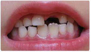 ما هو تفسير حلم سقوط الناب العلوي بدون ألم لابن سيرين؟ ما هو تفسير حلم سقوط الناب العلوي بدون ألم لابن سيرين؟التي تثير الدهشة والقلق لأن معظم