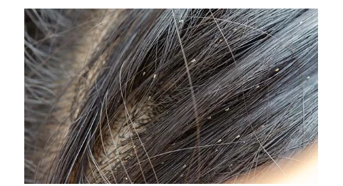 تعرف على تفسير حلم القمل الابيض لابن سيرين تفسير حلم القمل الابيض قد يكون إشارة إلى العديد من الدلالات المرتبطة بحياة الرائي، وذلك وفقا لما يراه من أحداث بالمنام، فقد يحلم أحدهم أن