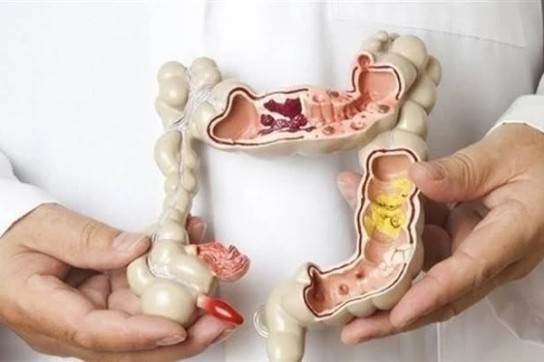 مرض القولون العصبي.. التعريف والتعامل معه.مرض القولون العصبي هو اضطراب شائع في الجهاز الهضمي يتسبب في آلام البطن وتغيرات في عادات الإخراج البرازي،