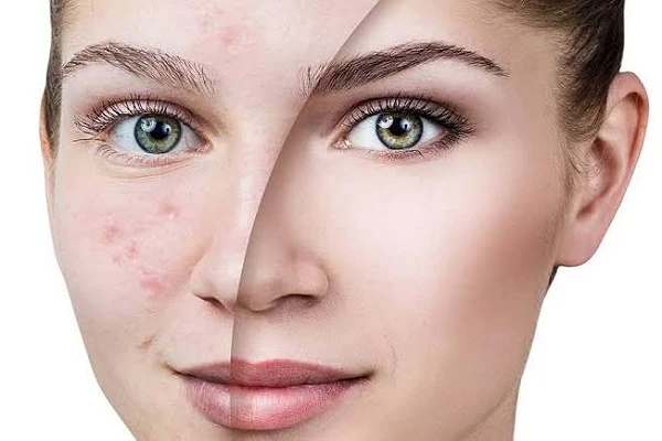 زيوت طبيعية فعالة في علاج آثار حبوب الشباب وتحسين بشرتك.تعد آثار حبوب الشباب من المشاكل الجلدية التي تؤثر على الكثير من الأشخاص، وقد تترك آثارا لا