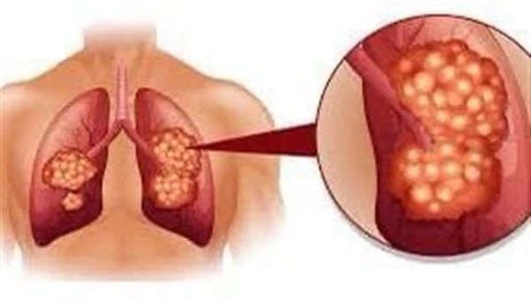 احذر إهمال علاجه.. مضاعفات خطيرة تحدث للمصابين بسرطان الرئةيعتبر سرطان الرئة نوع من السرطانات، والذي يبدأ في الرئتين، والرئة عبارة عن إسفنجيين في