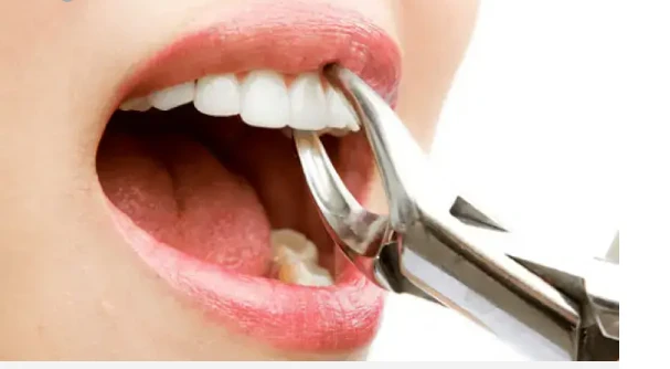 تعرف على تفسير خلع الضرس في المنام لابن سيرين والإمام الصادق خلع الضرس في المنام، هل رؤية خلع الضرس تبشر بالخير أم تنذر بالسوء؟ وما هي الدلالات السلبية لحلم خلع الضرس؟ وإلى ماذا يش