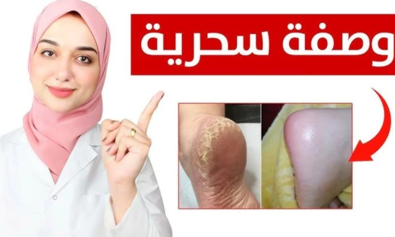 بمكونات من المنزل حضري ماسك لتنعيم القدمين واليدين للتخلص من التشققات وجفاف الجلد تسعى العديد من السيدات والفتيات لمعرفة وصفة طبيعية تساعد في التخلص