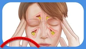 ما يجب تجنبه مع التهاب الجيوب الأنفية صحة وجمال شاهد المقال التالي من صحافة الأردن عن ما يجب تجنبه مع التهاب الجيوب الأنفية، السوسنة التهاب الجيوب