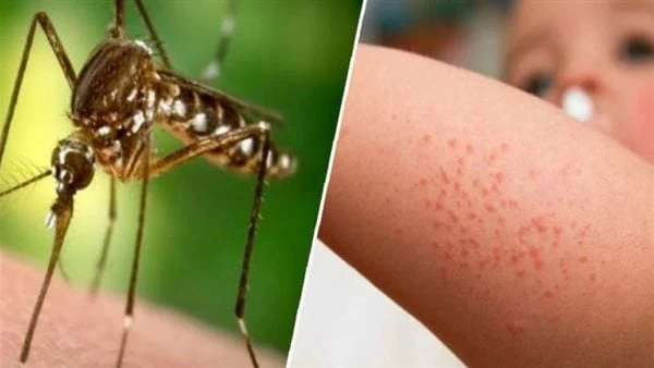 بعد ارتفاع عدد المصابين بدولة الاحتلال.. أعراض غير متوقعة لحمى غرب النيلأفادت القناة السابعة العبرية، اليوم الإثنين، بارتفاع عدد المصابين بحمى غرب النيل في إسرائيل، اليوم الإثنين،