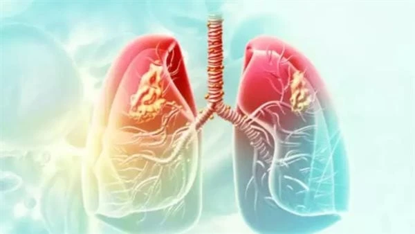 لا يظهر في المراحل الأولى.. أعراض واضحة تؤكد الإصابة بسرطان الرئةسرطان الرئة نوع من السرطانات، يبدأ في الرئتين، والرئتان عضوين إسفنجيين في الصدر