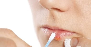 أسباب تقرحات الفم.. كيف تميزها عن بثور الحمى صحة وطب شاهد المقال التالي من صحافة مصر عن أسباب تقرحات الفم كيف تميزها عن بثور الحمى، قرح الفم وبثور