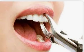 ما هو تفسير خلع السن في المنام لابن سيرين؟ ما هو تفسير خلع السن في المنام لابن سيرين؟الكثير منا يراوده العديد من الأحلام المزعجة التي تسبب حالة من